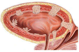 Địa chỉ vàng: Các bệnh viện điều trị tốt ung thư bàng quang