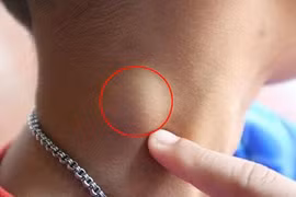 Nổi hạch bất thường, đừng nên chủ quan