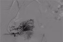 Ra máu âm đạo ồ ạt do bất thường mạch máu tử cung hiếm gặp