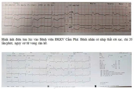 Viêm cơ tim, người phụ nữ 45 tuổi nguy cơ tử vong cận kề