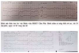 Viêm cơ tim, người phụ nữ 45 tuổi nguy cơ tử vong cận kề