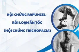 Lấy khối tóc lớn trong dạ dày bé 7 tuổi thích ăn tóc