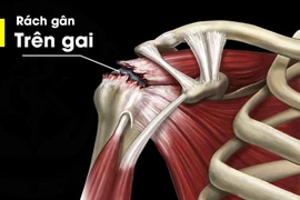 Đau khớp vai cẩn thận teo cơ, vai đông cứng mất chức năng