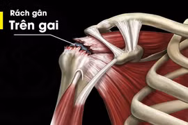 Đau khớp vai cẩn thận teo cơ, vai đông cứng mất chức năng