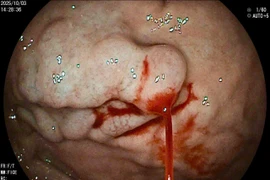 Đau bụng, đầy hơi nhập viện, người đàn ông mới biết bị xuất huyết tiêu hóa 