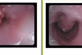 Nuốt nghẹn, người bệnh nam bất ngờ phát hiện khối u thực quản kích thước lớn