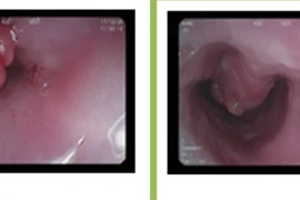 Nuốt nghẹn, người bệnh nam bất ngờ phát hiện khối u thực quản kích thước lớn