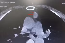 Cắt toàn bộ tuyến ức kèm u cho người phụ nữ 65 tuổi 