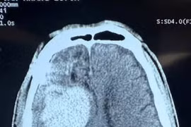 Chấn thương sọ não sau lên cơn động kinh, cách gì phát hiện sớm?