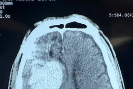 Chấn thương sọ não sau lên cơn động kinh, cách gì phát hiện sớm?