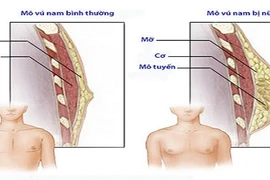 Nam giới phì đại tuyến vú, cẩn thận ung thư