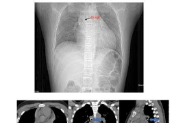 Bé 13 tuổi nguy hiểm tính mạng vì đinh ghim sắc nhọn rơi vào đường thở