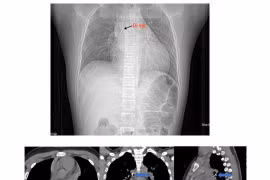 Bé 13 tuổi nguy hiểm tính mạng vì đinh ghim sắc nhọn rơi vào đường thở