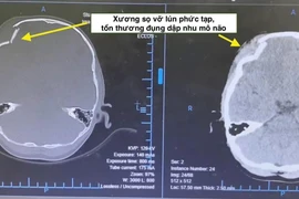 Hội chẩn liên viện cứu sống trẻ 5 tuổi chấn thương sọ não nặng