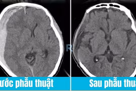 1 đêm sau cú vấp nhẹ, người đàn ông 55 tuổi bị tụ máu não nguy kịch
