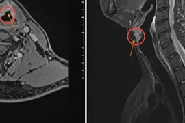 Khàn giọng tưởng hút thuốc, nói nhiều không ngờ ung thư thanh quản