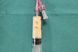 Mỡ máu tăng gấp hơn 100 lần, bệnh nhân nguy kịch vì viêm tụy cấp