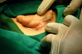 Phẫu thuật ca viêm sụn vành tai tái phát hiếm gặp