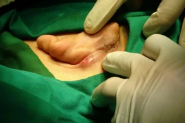 Phẫu thuật ca viêm sụn vành tai tái phát hiếm gặp