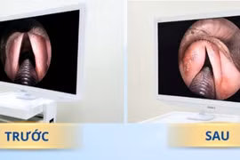 Điều trị thành công ca hở thanh môn do liệt dây thanh bằng tiêm mỡ tự thân
