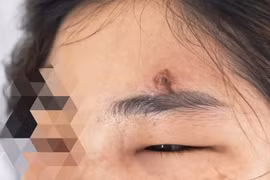 Nặn mụn trứng cá, nữ bệnh nhân nguy cơ nhiễm khuẩn huyết