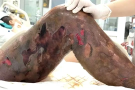 Vết gai đâm gây sốc nhiễm trùng, suy đa tạng, người đàn ông suýt tử vong