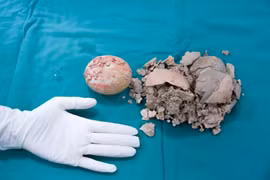 Sống chung sỏi bàng quang 30 năm, cô gái đau đớn vì sỏi 10cm