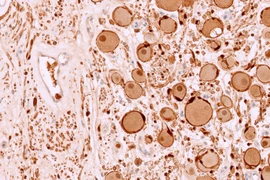 Điều trị sởi, bé 7 tuổi phát hiện khối u thần kinh hiếm gặp