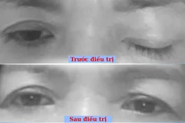 Phục hồi sụp mi mắt, nhìn đôi sau tai nạn do liệt dây thần kinh III