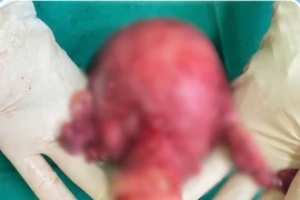 Ổ mủ tử cung khổng lồ suýt cướp đi mạng sống người phụ nữ Campuchia