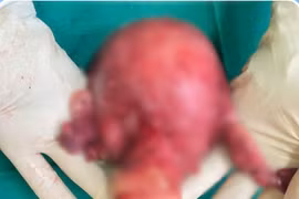 Ổ mủ tử cung khổng lồ suýt cướp đi mạng sống người phụ nữ Campuchia