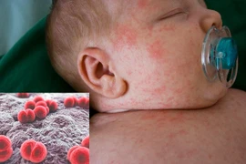 Trẻ sơ sinh sốc nhiễm trùng, suy hô hấp do viêm não mô cầu