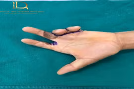 Phẫu thuật tạo hình điều trị sẹo co kéo phức tạp bàn ngón tay 25 năm