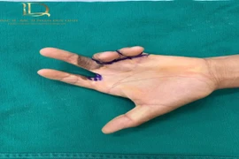 Phẫu thuật tạo hình điều trị sẹo co kéo phức tạp bàn ngón tay 25 năm
