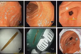Trẻ đau bụng dữ dội do tăm tre cắm sâu vào thành dạ dày