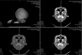 Tai nạn tại nhà, trẻ 6 tuổi ngừng tim, chấn thương sọ não nặng