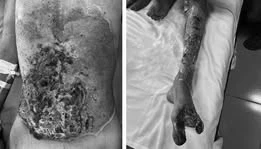 Đắp lá chữa bỏng, thanh niên 22 tuổi bị hoại tử nghiêm trọng