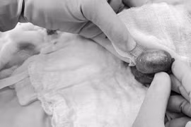 Chạy đua với 'giờ vàng' bảo tồn thành công tinh hoàn cho chàng trai 20 tuổi