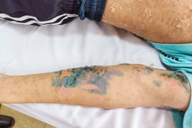 Da bong tróc do tắm lá chữa sởi