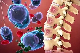 Dấu hiệu nhận biết sớm bệnh xơ tủy