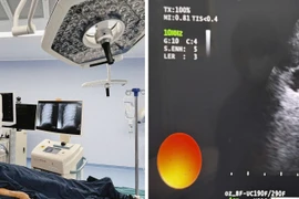 Ca bệnh đầu tiên Việt Nam nội soi phế quản thực hiện sinh thiết lõi 