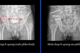 Gãy xương nguy kịch vì tự sửa mái nhà