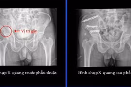 Gãy xương nguy kịch vì tự sửa mái nhà