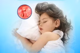 Trẻ ngưng thở khi ngủ ngáy, cha mẹ không nên chủ quan