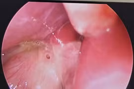 Cảnh báo nguy cơ thủng dạ dày ở trẻ em ngày càng tăng