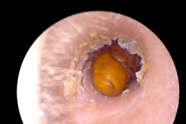 Đau nhức tai kéo dài không ngờ do côn trùng di chuyển