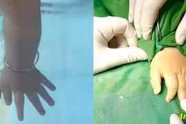 Dị tật bẩm sinh ngón tay thừa gây mất chức năng vận động
