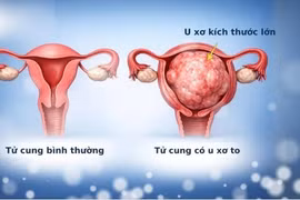 Chưa chồng, u xơ tử cung lớn đã lan từ tiểu khung lên ổ bụng