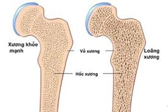 Vì sao nhiều người trẻ mắc bệnh loãng xương?