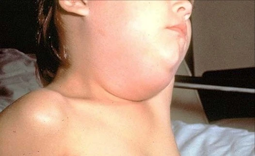 Nhận biết sớm dấu hiệu bệnh quai bị ở trẻ em giúp hạn chế biến chứng